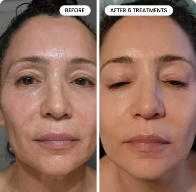 Micro Infusion System Hydra Serum