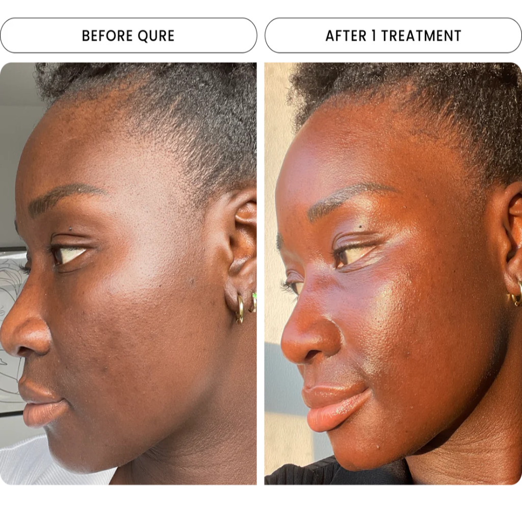 Micro Infusion System Hydra Serum
